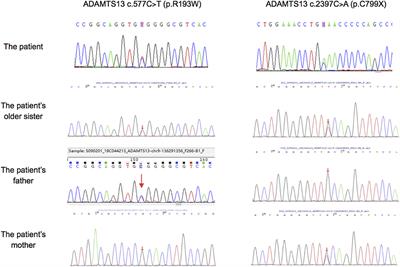 Hereditary Thrombotic Thrombocytopenic Purpura in a Chinese Boy With a Novel Compound Heterozygous Mutation of the ADAMTS13 Gene